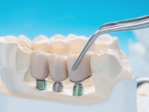 Acme Dental Crown Bridges