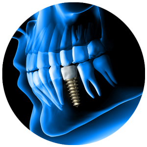 Acme Dental Dental implants