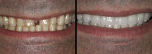 Acme Dental Veneers tooth