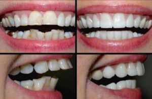 Acme Dental Smile make over