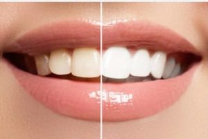 Acme Dental teeth whitening