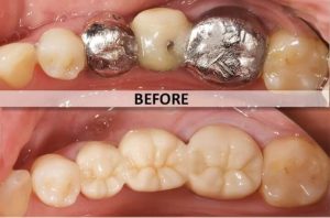 Acme Dental crown replacment