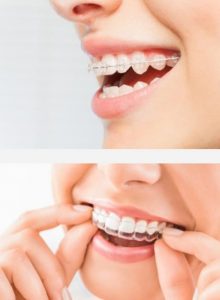 Acme Dental braces teeth