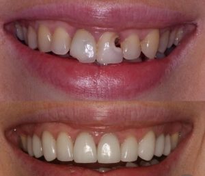 Acme Dental broken teeth changing