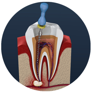 Acme Dental root canal treatment