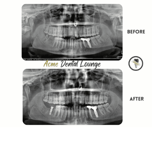Dental Implant - before and after