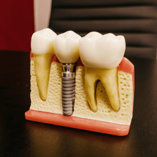 Dental implant - Acme Dental lounge