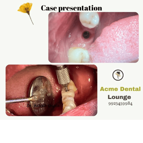 Dental Implant - case presentation