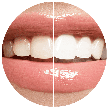 Teeth Whitening Treatment in Pune